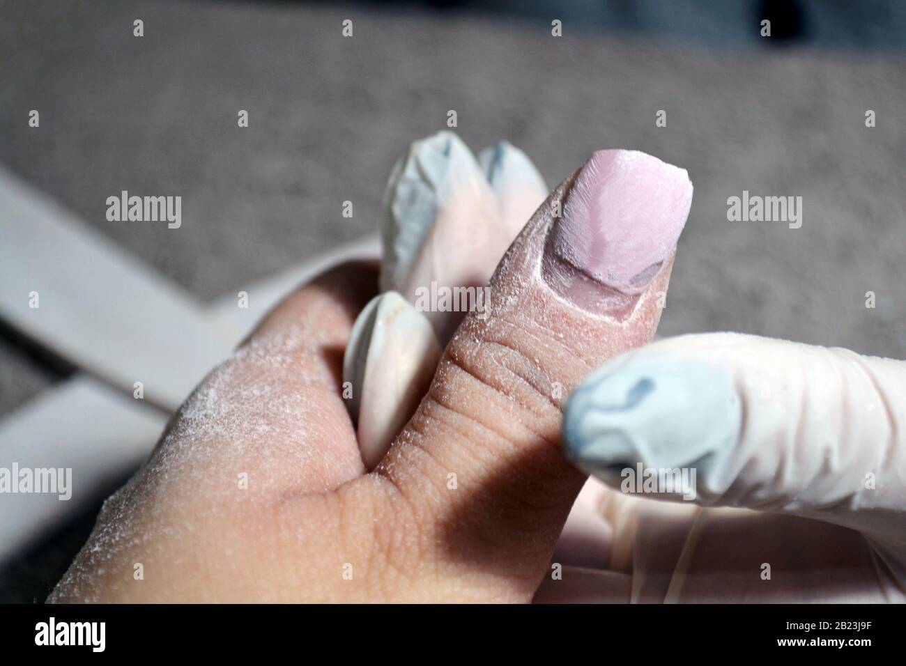 Uña del dedo roto fotografías e imágenes de alta resolución - Alamy