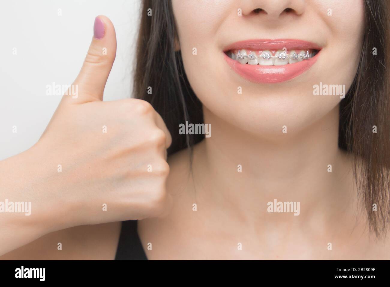 Aparatos dentales en la boca de mujeres felices que se muestra como. Soportes en los dientes después del blanqueamiento. Soportes autoligantes con bridas metálicas y elásticos grises Foto de stock