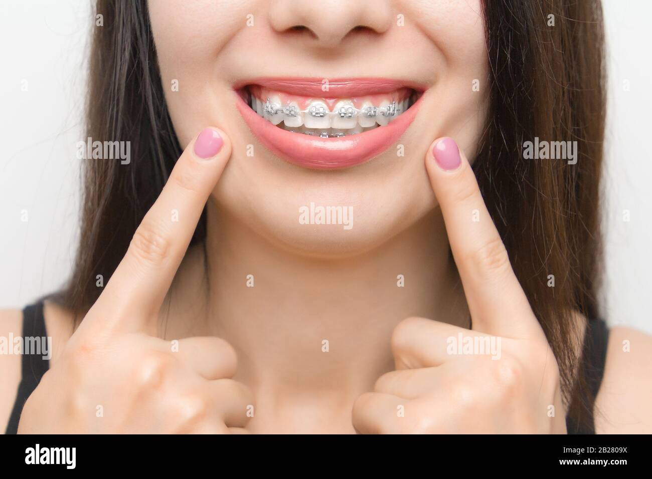Aparatos dentales en la boca de las mujeres felices que se muestran con dos dedos en los soportes de los dientes después del blanqueamiento. Soportes autoligantes con bridas metálicas y. Foto de stock