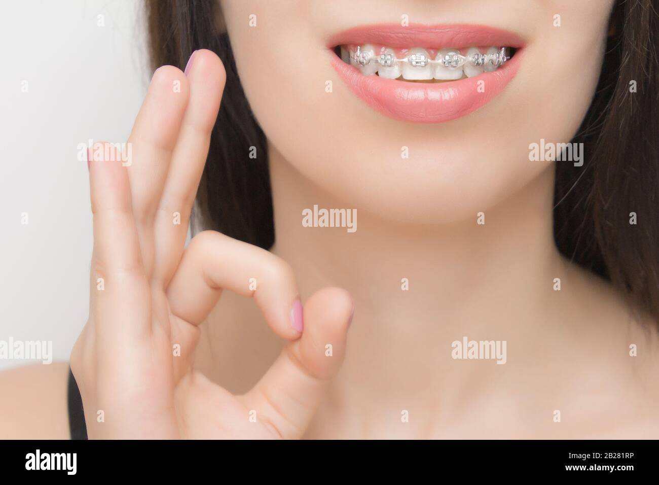 Aparatos dentales en la boca de mujeres felices que se muestra bien. Soportes en los dientes después del blanqueamiento. Soportes autoligantes con bridas metálicas y elásticos grises o. Foto de stock