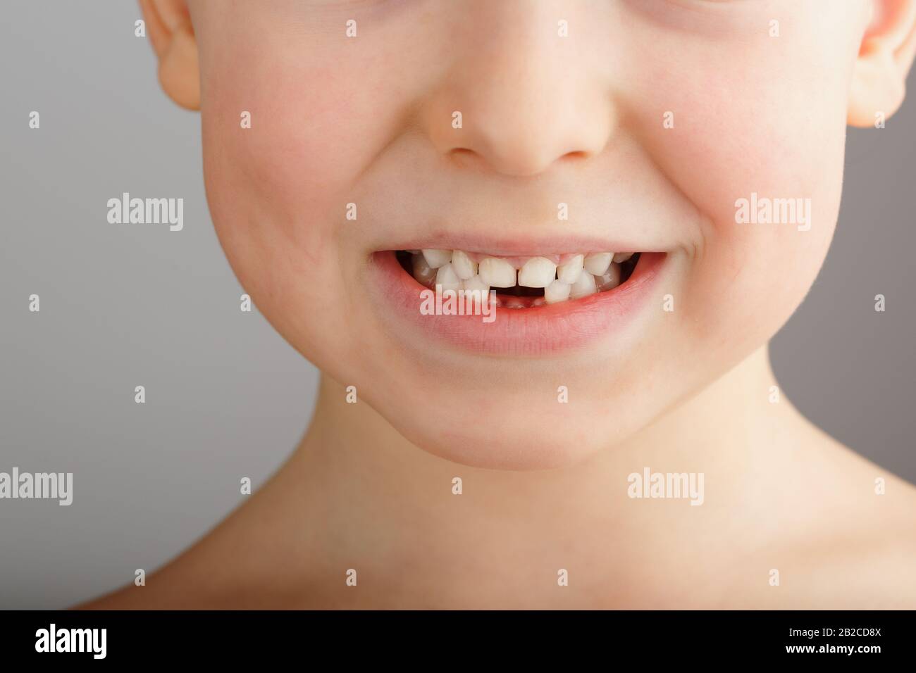 La sonrisa de un niño sin los dientes inferiores del bebé. Un agujero