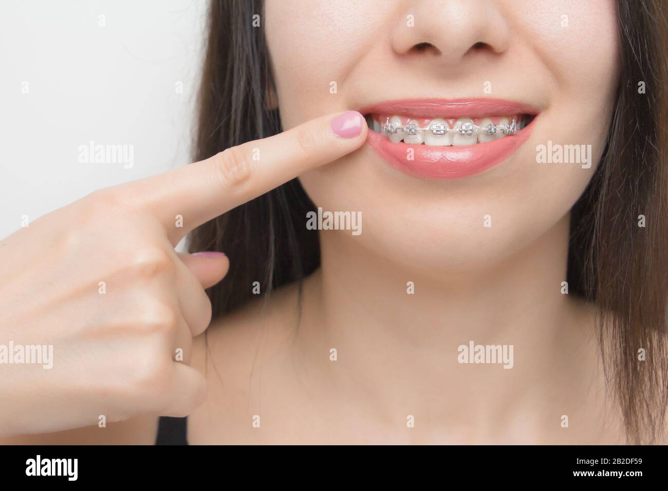 Aparatos dentales en la boca de las mujeres felices que se muestran con el dedo en los corchetes de los dientes después del blanqueamiento. Soportes autoligantes con bridas metálicas y grises Foto de stock