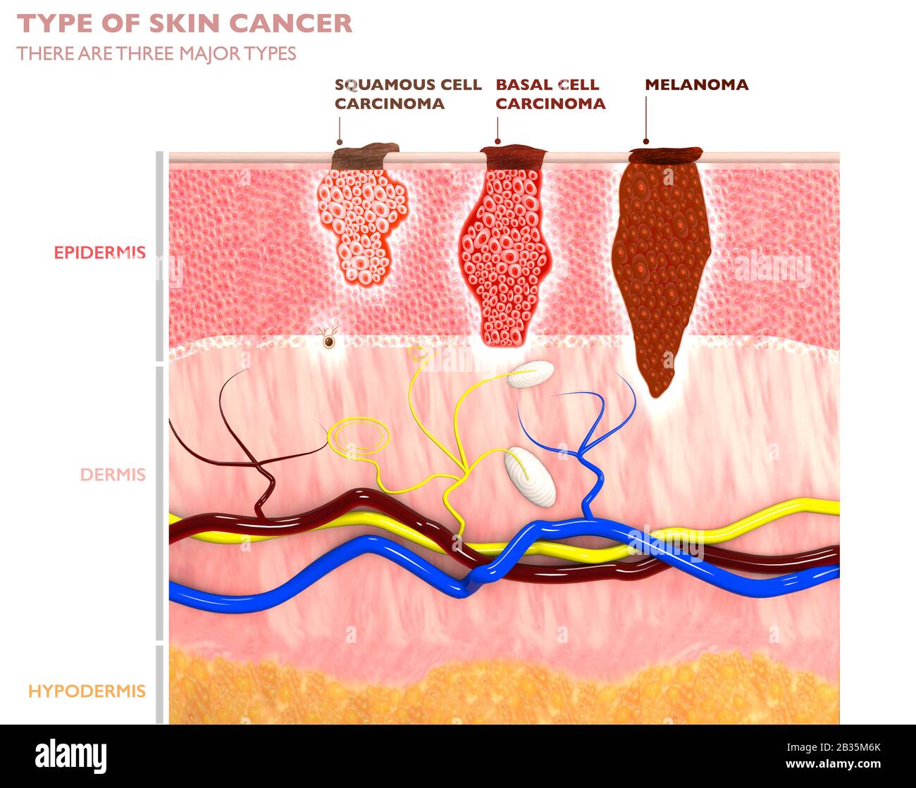 Tumores de piel, lunares y manchas, sección 3d de la capa de piel. Tres tipos de cáncer de piel, carcinoma de células escamosas, carcinoma de células basales, melanoma Foto de stock