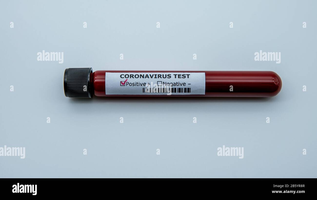 Tubo de muestra de sangre para la prueba de corona, COVID-19. El virus ha causado una situación de emergencia. Investigación de vacunas 2019-nCoV. Investigación contra i transmisible Foto de stock