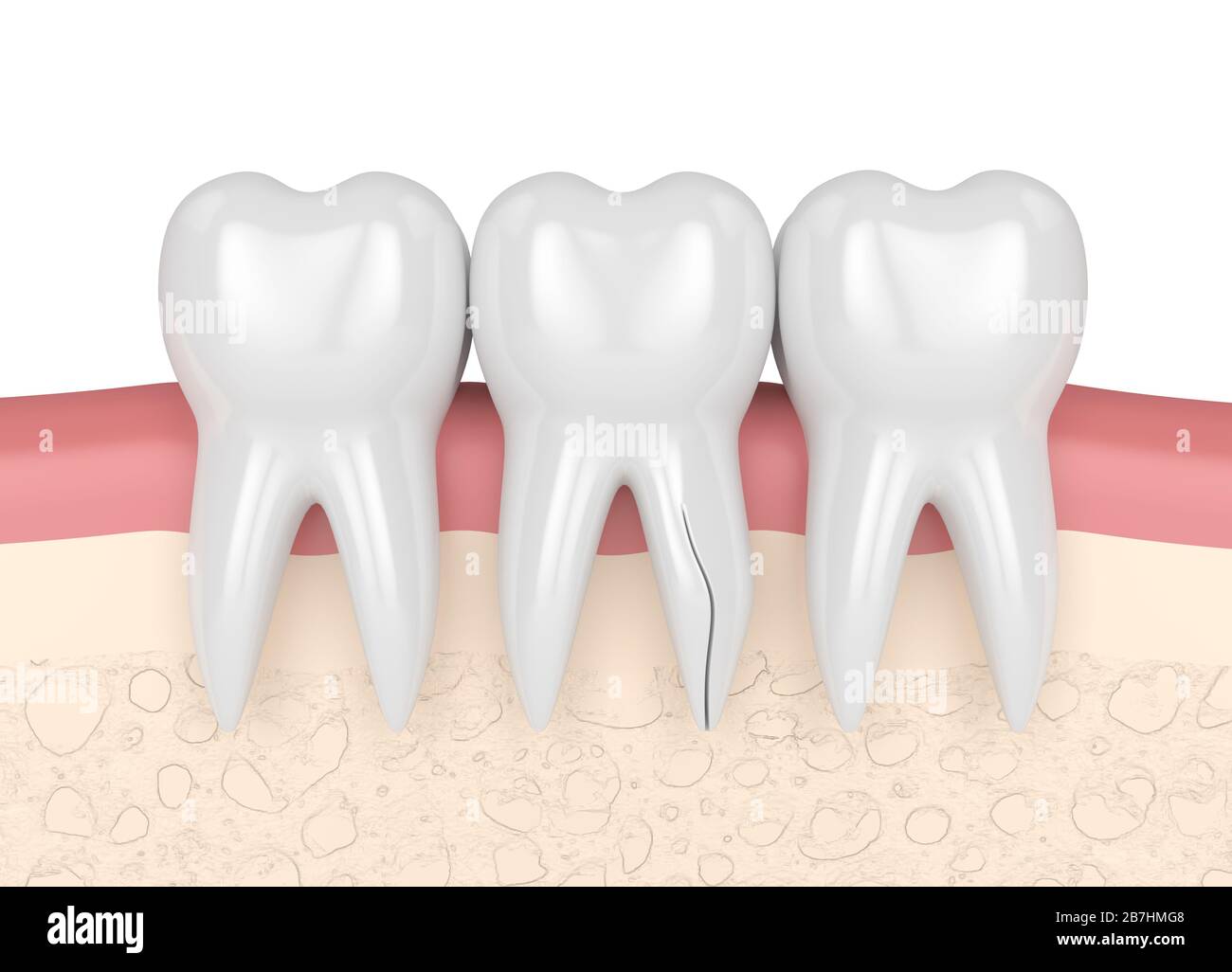 renderización 3d de encías con raíz de diente agrietada sobre fondo