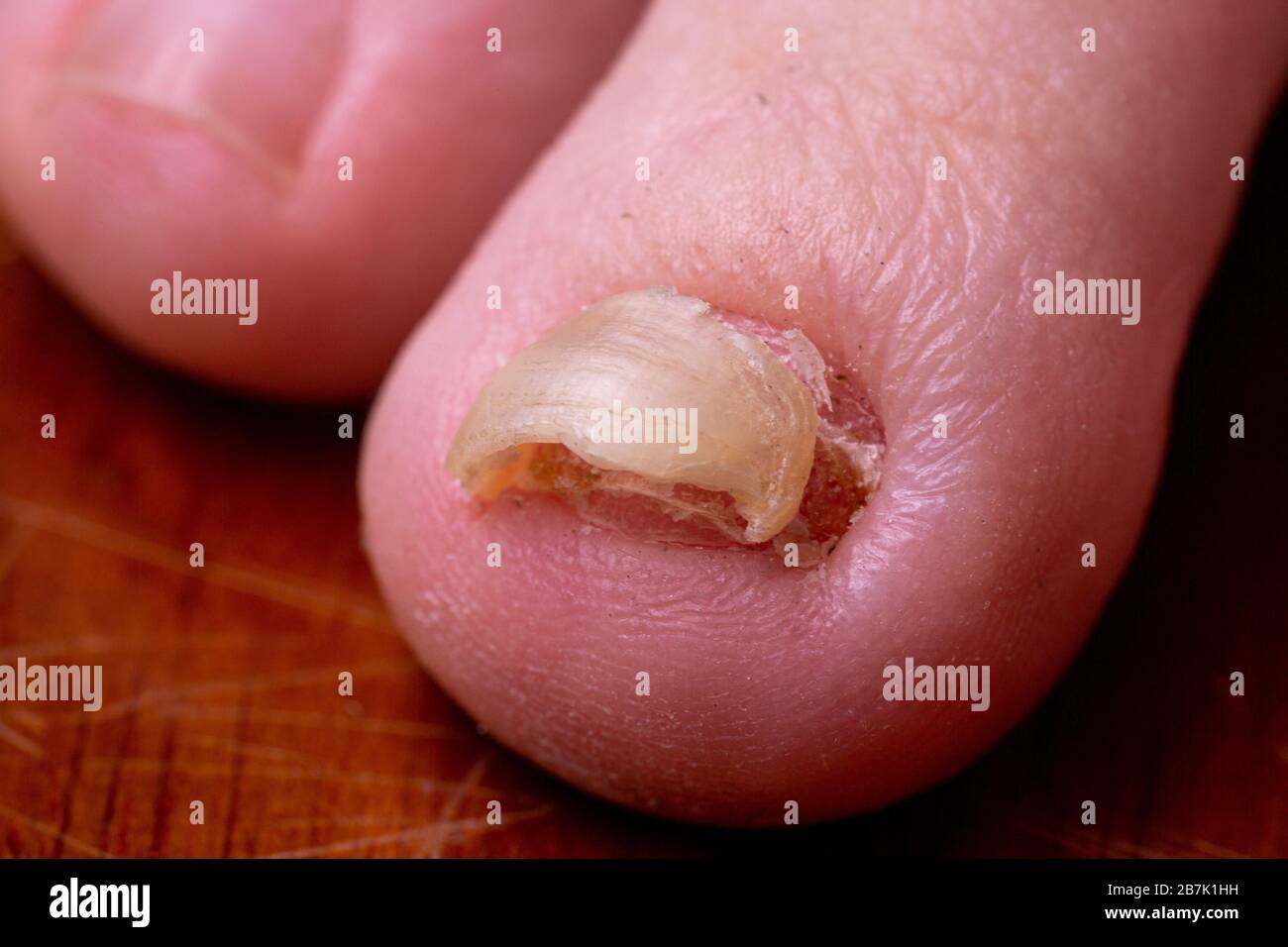 Primer plano macro de un dedo del pie con micosis trichophyton debajo de una uña desfigurada que se suelta. Coloración marrón amarilla de una uña de tiza Foto de stock