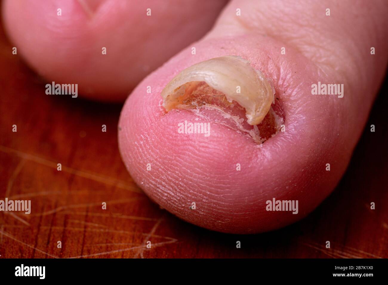 Super primer plano macro de un dedo del pie con micosis trichophyton debajo de una uña desfigurada. Coloración marrón amarilla de una uña de tiza suelta Foto de stock