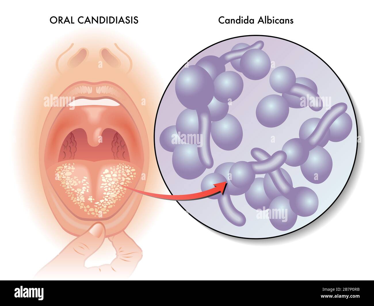 Ilustración médica de una infección lingual llamada candidiasis oral. Foto de stock
