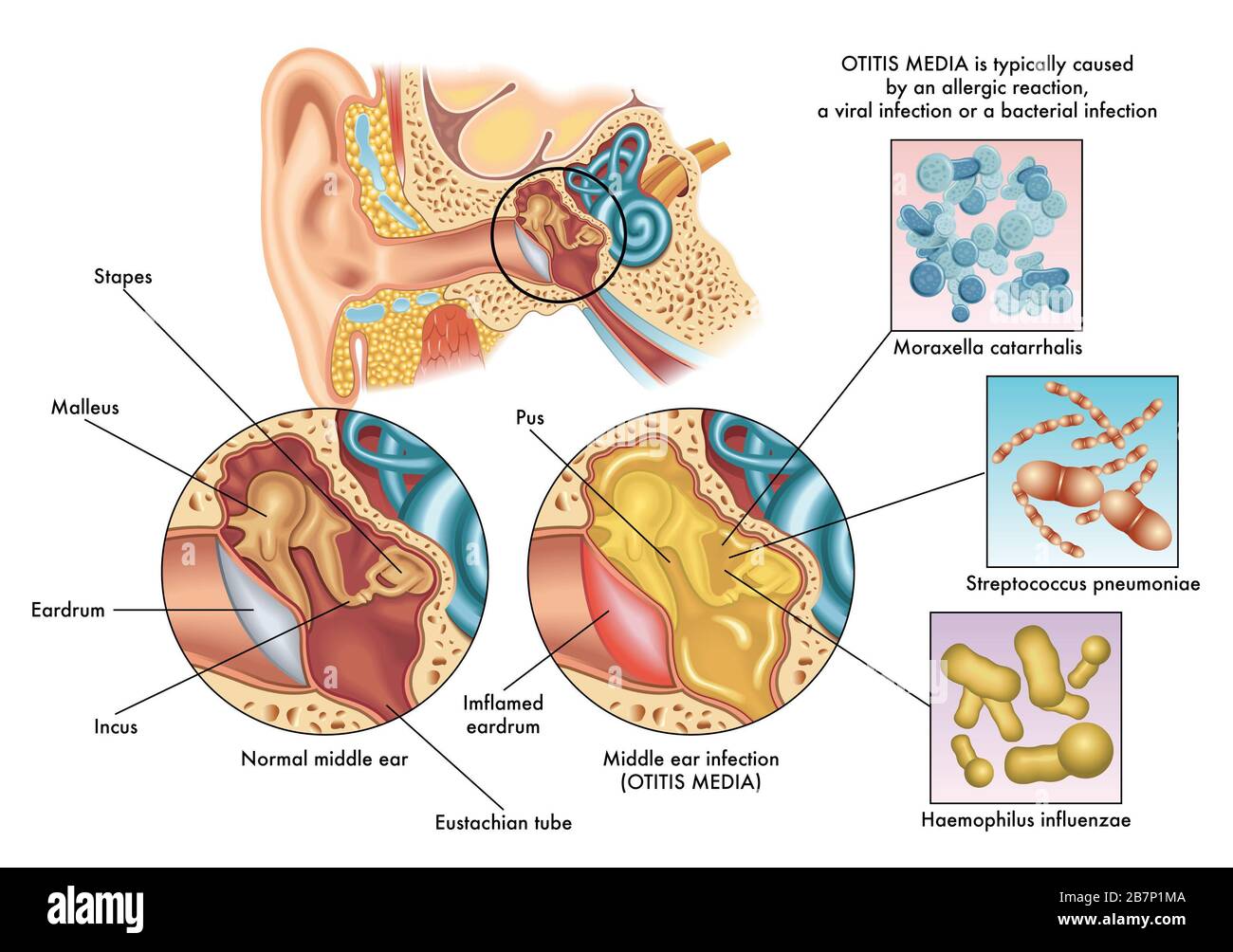 Ilustración médica de los síntomas de la otitis media. Foto de stock