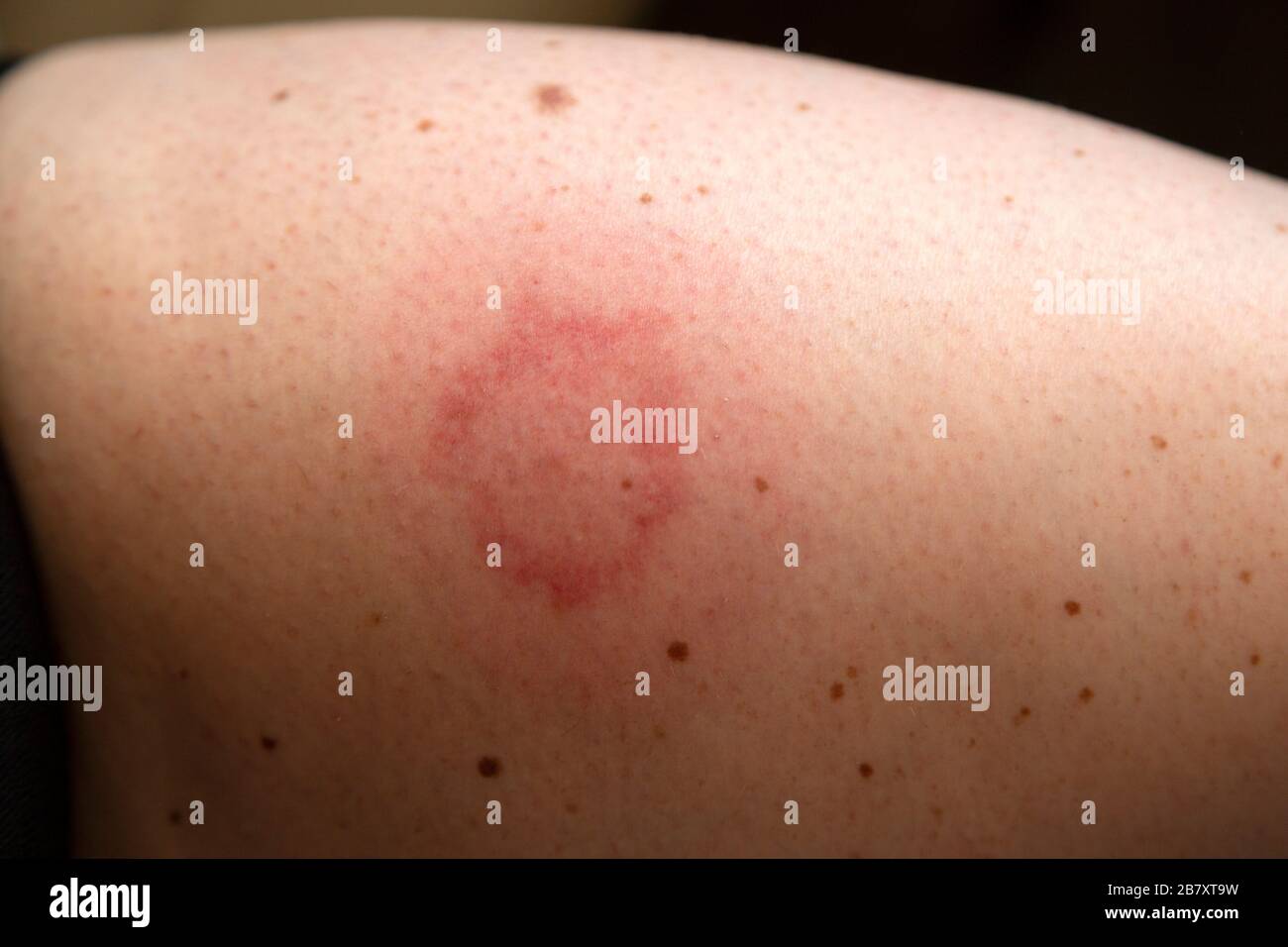 Enrojecimiento alrededor de una picadura de insecto. La mordedura ha