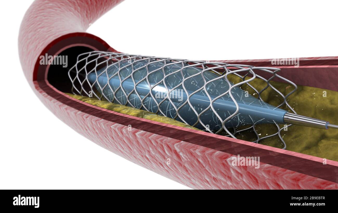 Sección transversal de la arteria que muestra angioplastia y despliegue del stent. Foto de stock