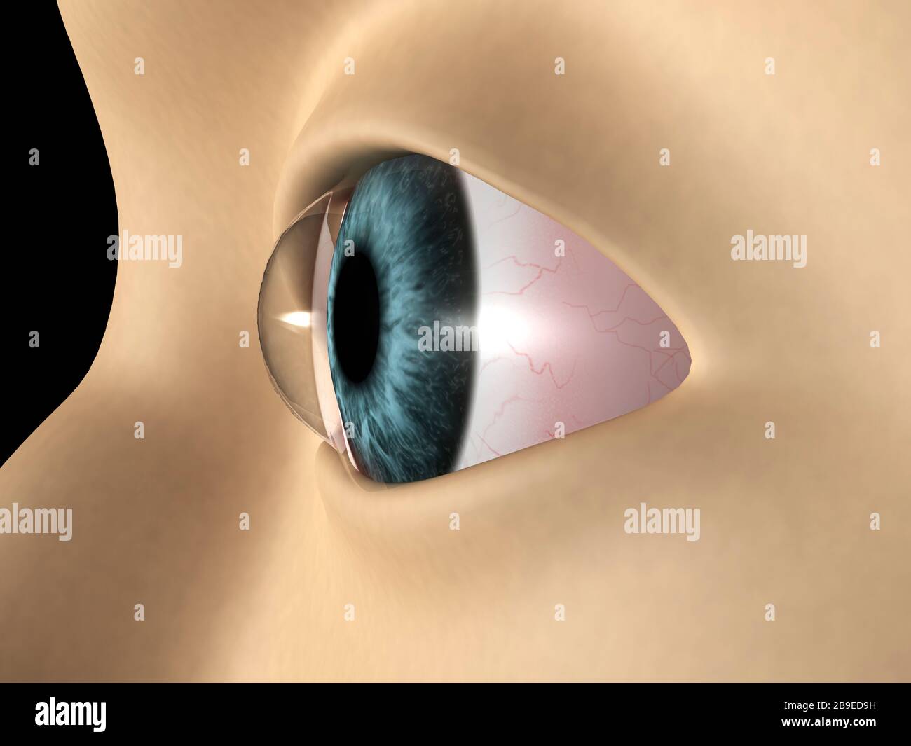 Ilustración médica que muestra queratocono en el ojo. Foto de stock