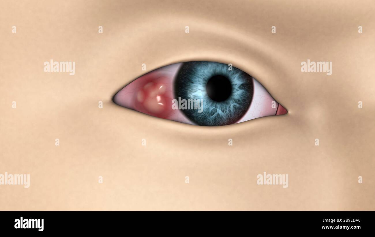 Cáncer de ojo fotografías e imágenes de alta resolución - Alamy