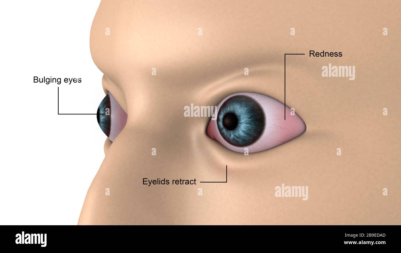 Ilustración médica de exoftalmos, abultamiento de los ojos. Foto de stock