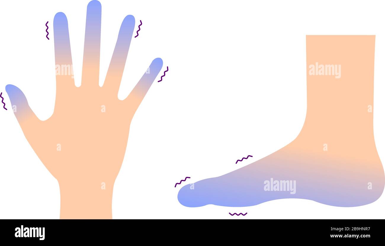 Ilustración de la circulación de manos y pies fríos / sangre (sensibilidad  al frío Imagen Vector de stock - Alamy