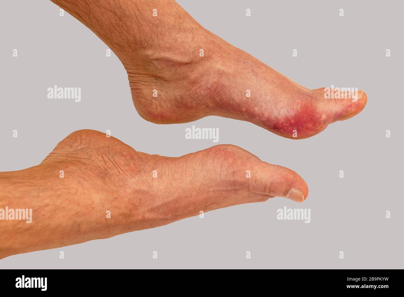 Enfermedad de los pies el reumatismo y la gota. Hinchazón de la pierna  roja. Dolor en el pie Fotografía de stock - Alamy