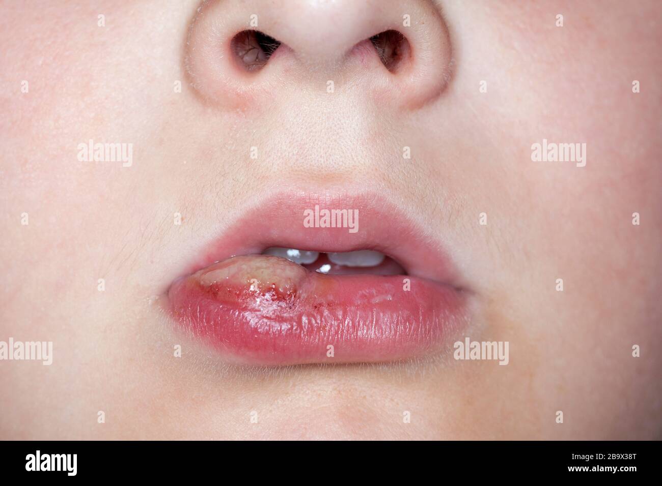 Llagas en la cara fotografías e imágenes de alta resolución Alamy