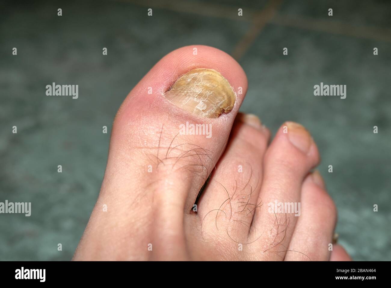 Dedos humanos con uñas enfermas de micosis onycho, salud dermatológica, médica Foto de stock