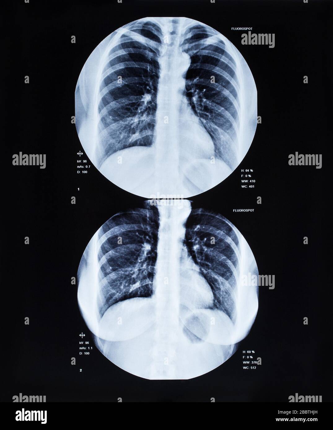 Imagen de rayos X de tórax humano para un diagnóstico médico Fotografía