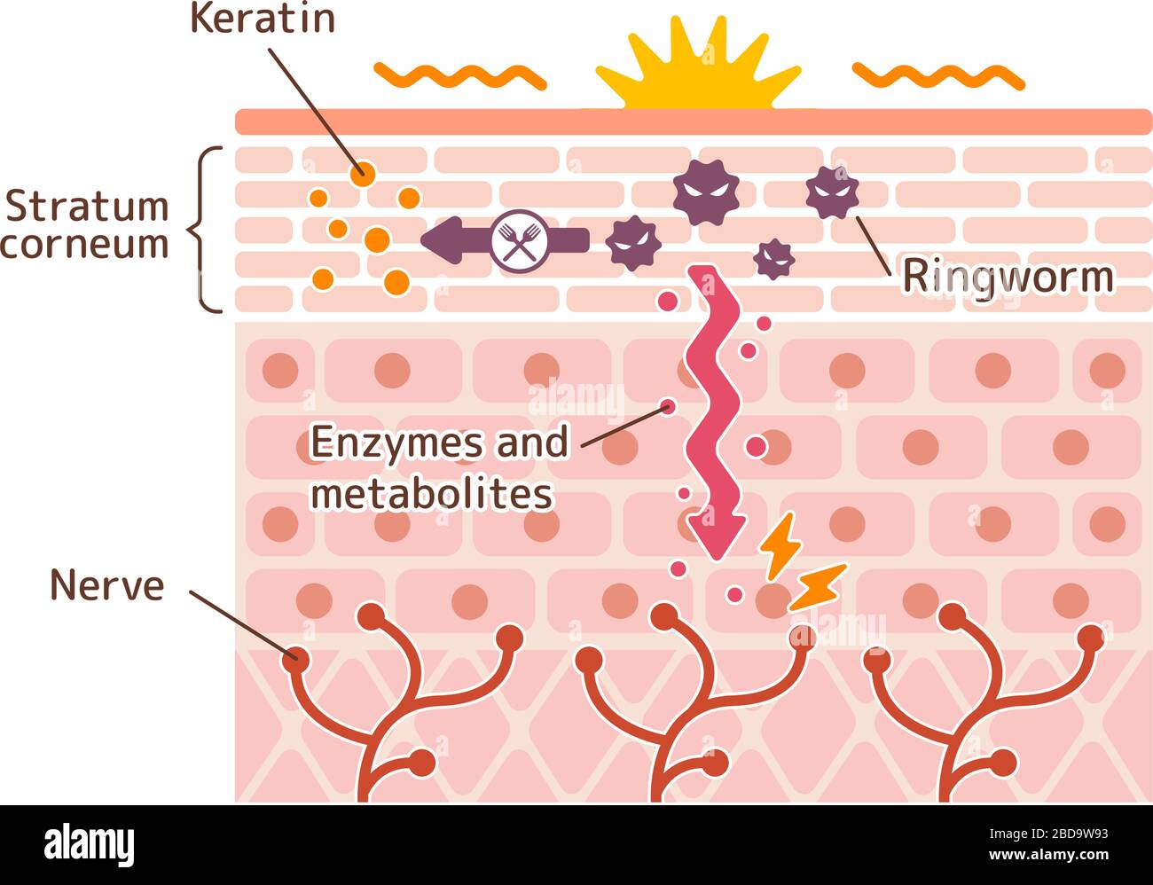 Generación mecanizim de pie de atleta (tiña) ilustración vectorial