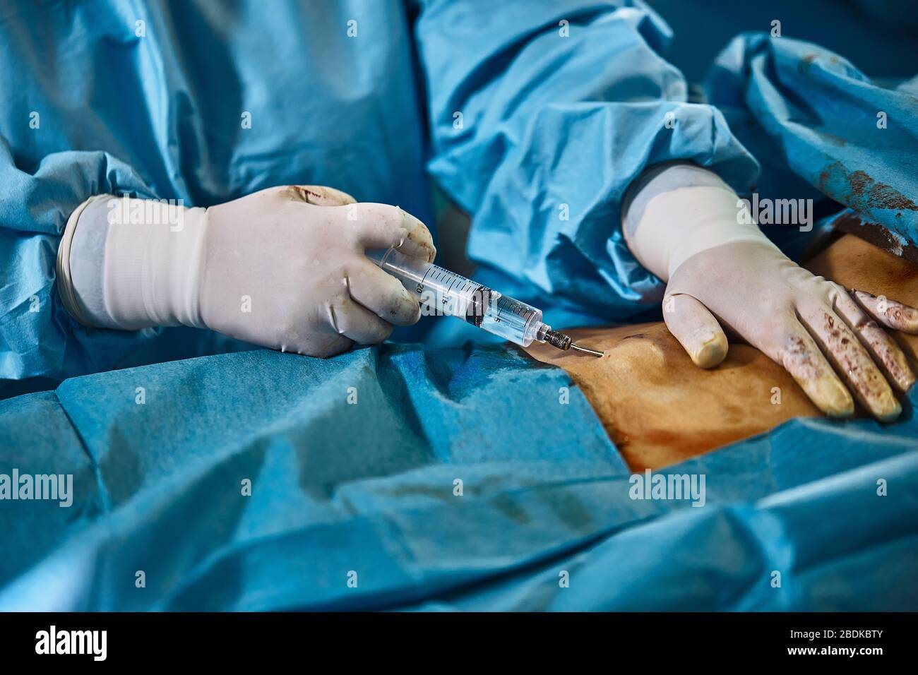 Operación quirúrgica liposucción del abdomen. Primer plano del paciente