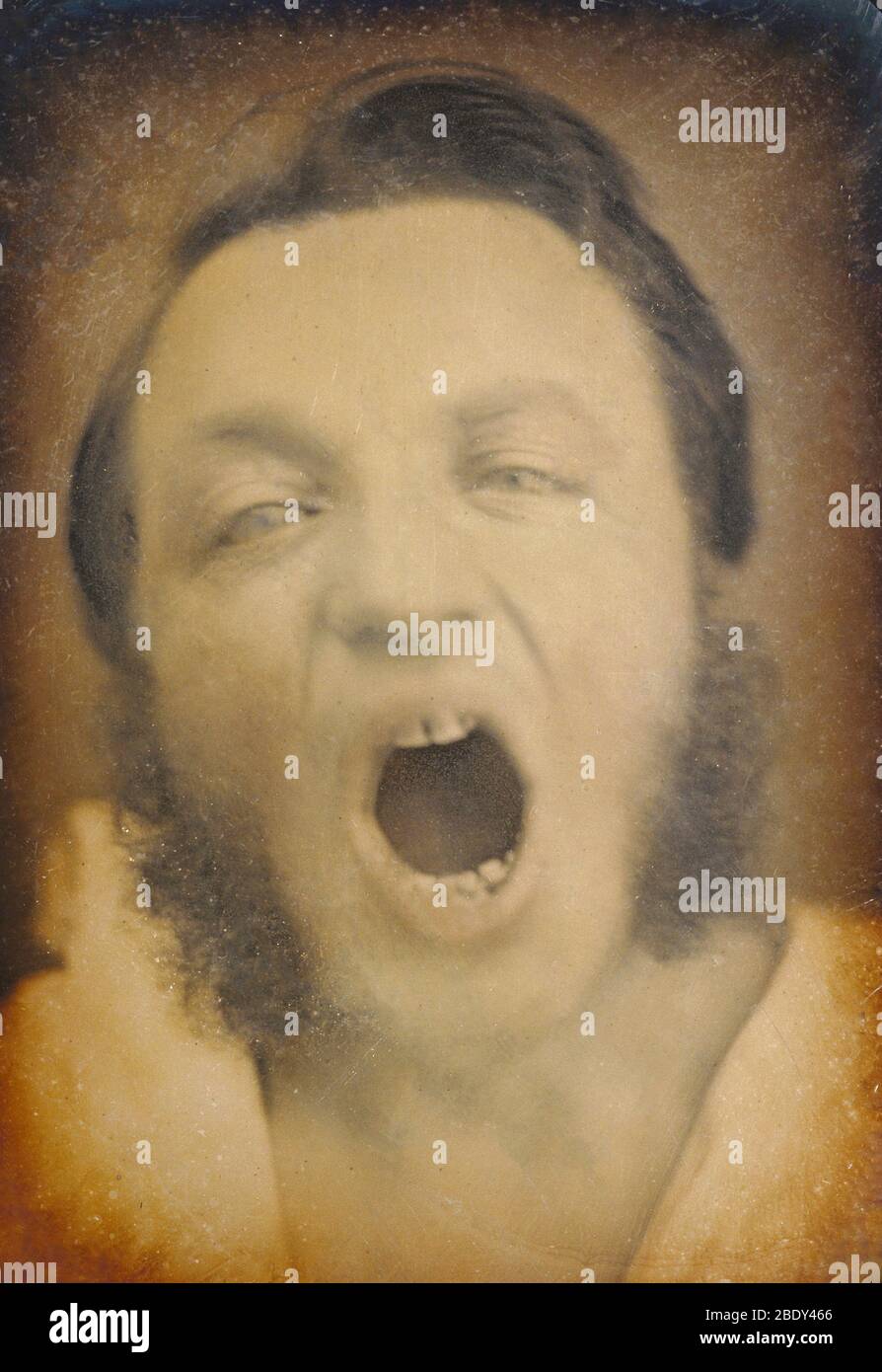 Hombre con dientes y encías enfermos, 1852 Foto de stock