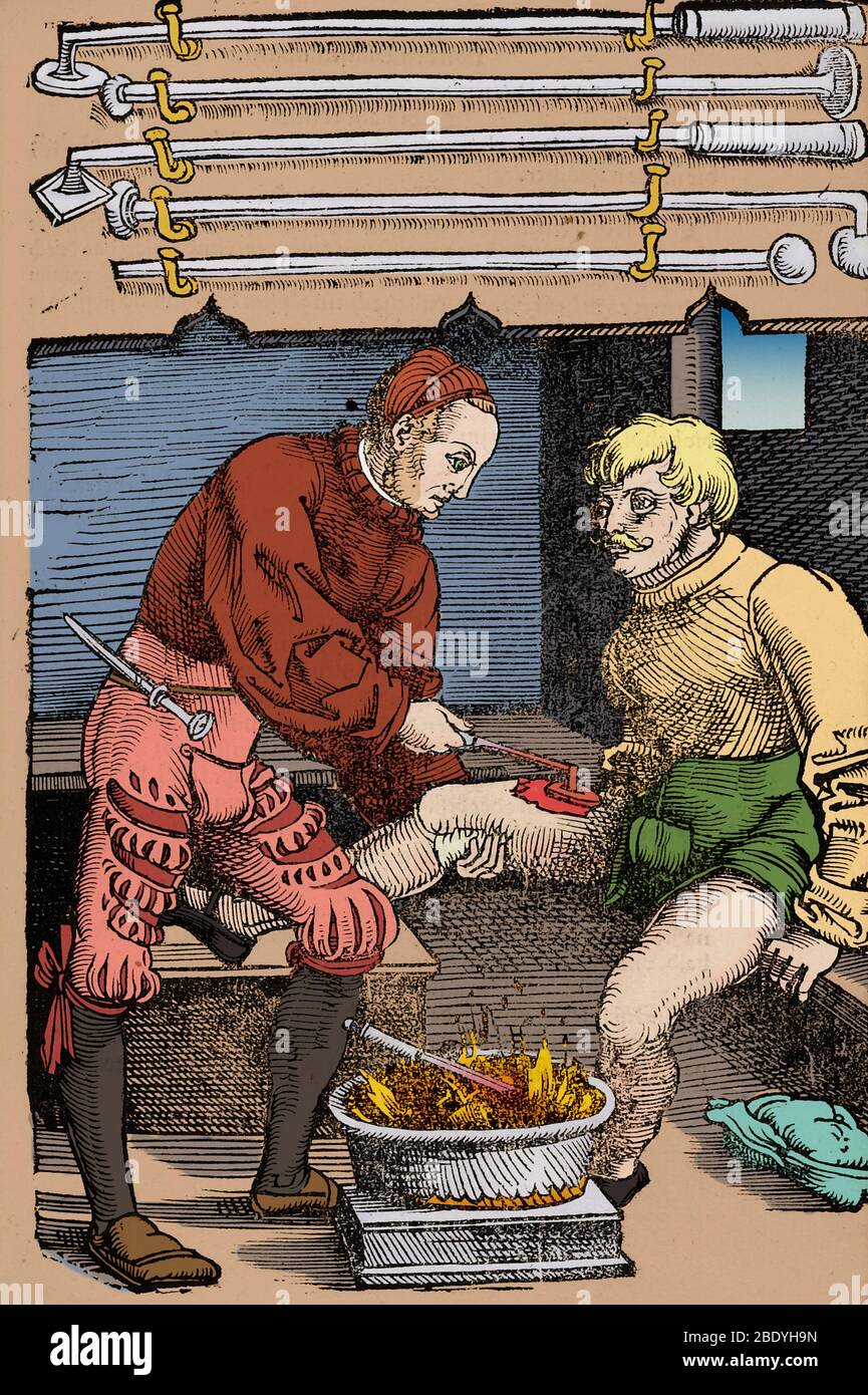 Cauterization fotografías e imágenes de alta resolución Alamy