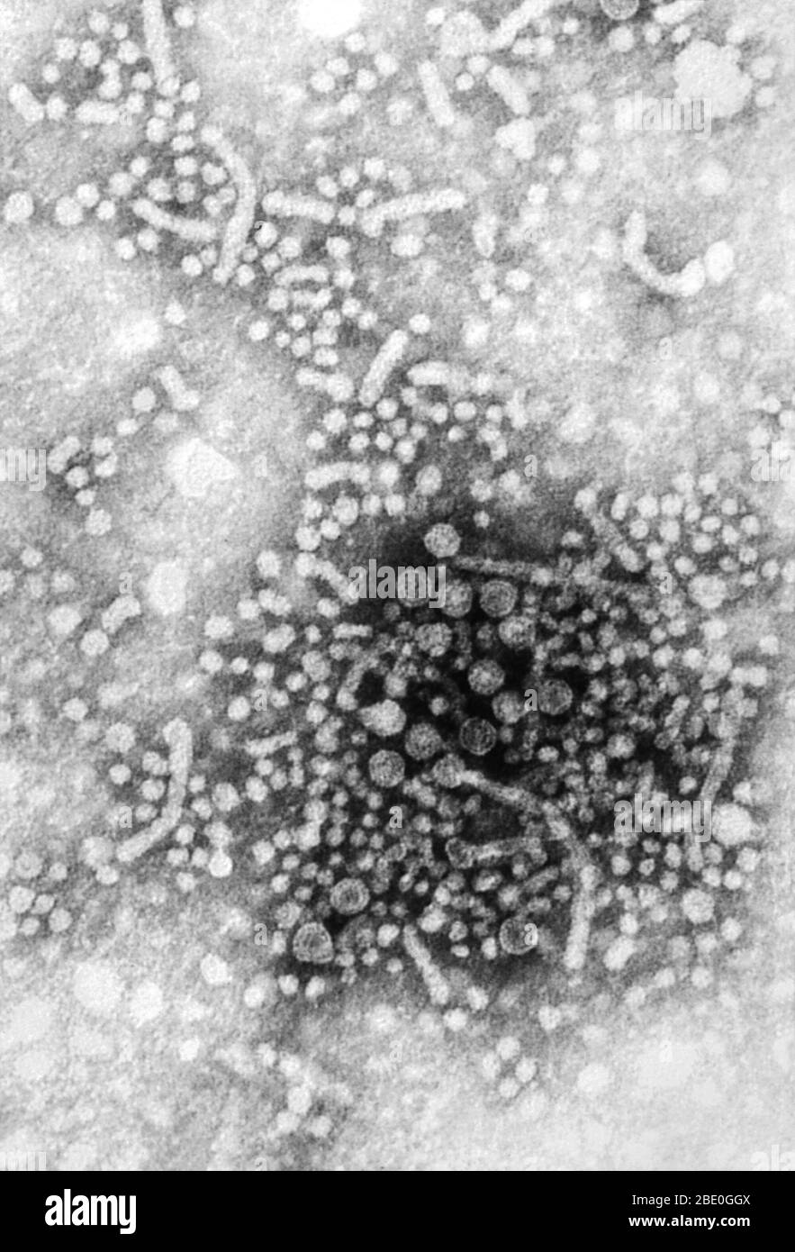 Micrografía electrónica de transmisión con tinción negativa (TEM) de numerosos viriones del virus de la hepatitis B (VHB), también conocidos como partículas de Dane. El VHB contiene un genoma de ADN y es miembro de la familia de virus conocidos como Hepadnaviridae. Es la causa de una enfermedad grave que ataca el hígado y una infección que puede durar toda la vida, conocida como cirrosis (cicatrización) del hígado, cáncer de hígado, insuficiencia hepática y muerte. Foto de stock