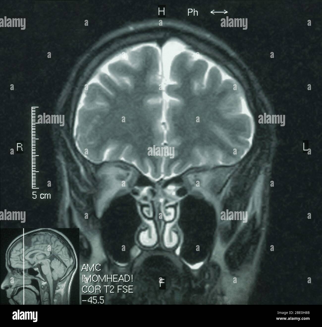 RM del cerebro (vista sagital) de un varón de 26 años. La resonancia magnética se tomó como resultado de una lesión en la cabeza en un accidente de automóvil. El diagnóstico de la IRM es un pequeño quiste aracnoideo en la región frontal izquierda anterior parasigital. Todos los demás aspectos parecen normales. Foto de stock