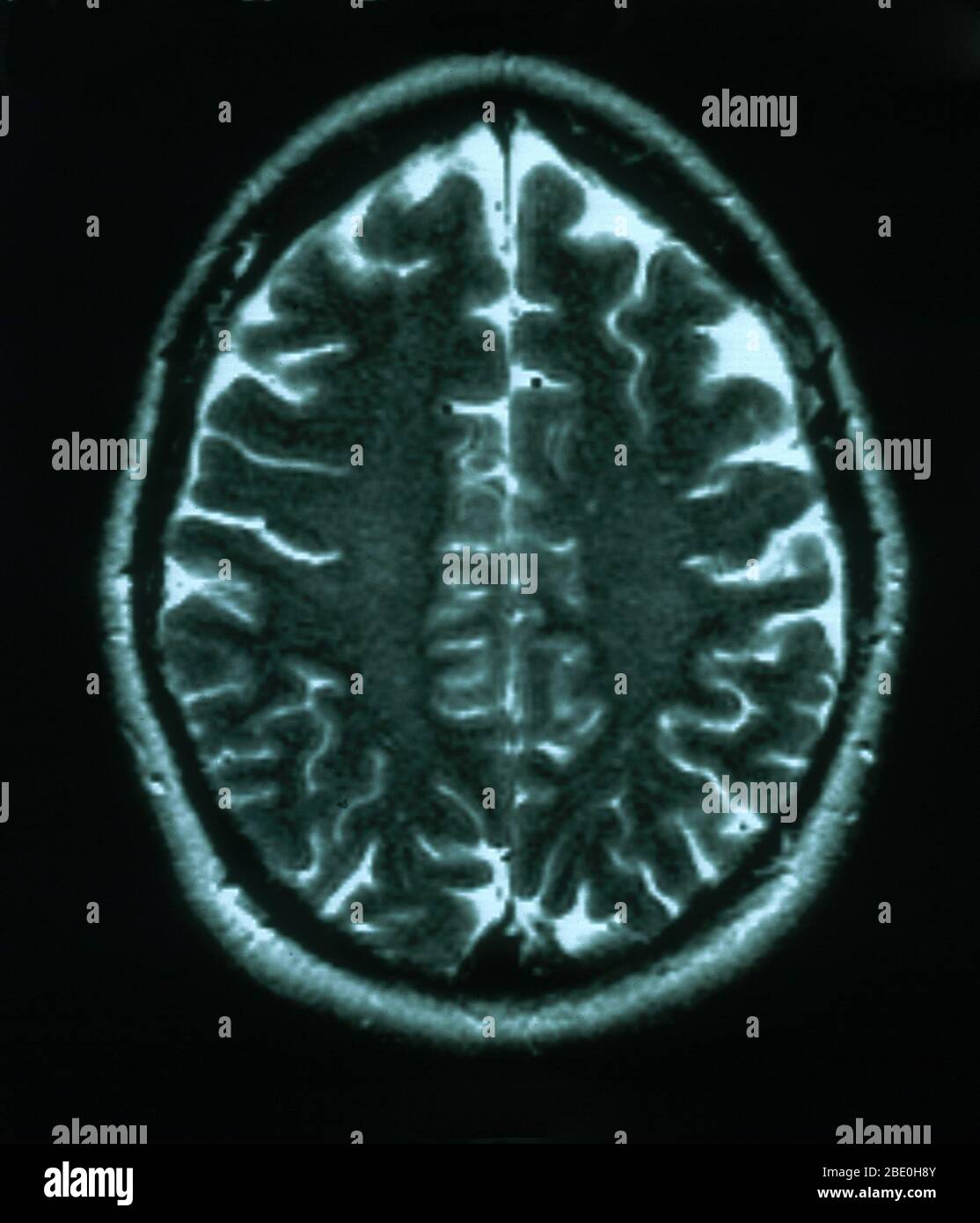 IRM, vista axial ponderada en T2 a través del cerebro de una mujer de 54 años. La resonancia magnética es normal. Foto de stock