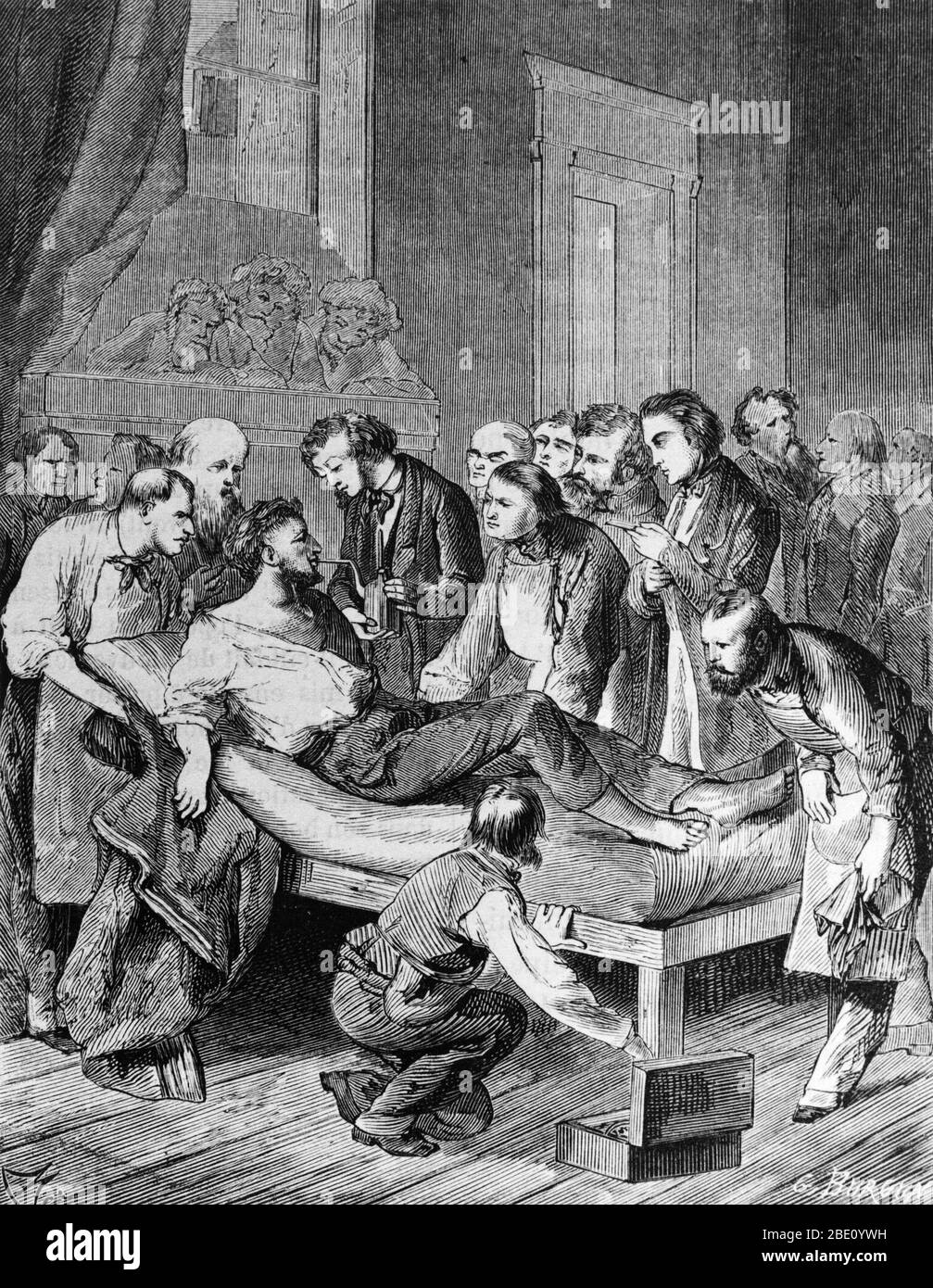Grabado que muestra a los médicos que administran éter sulfúrico a un paciente antes de extirpar un tumor del cuello en 1846, marcando la primera operación realizada bajo anestesia. Foto de stock