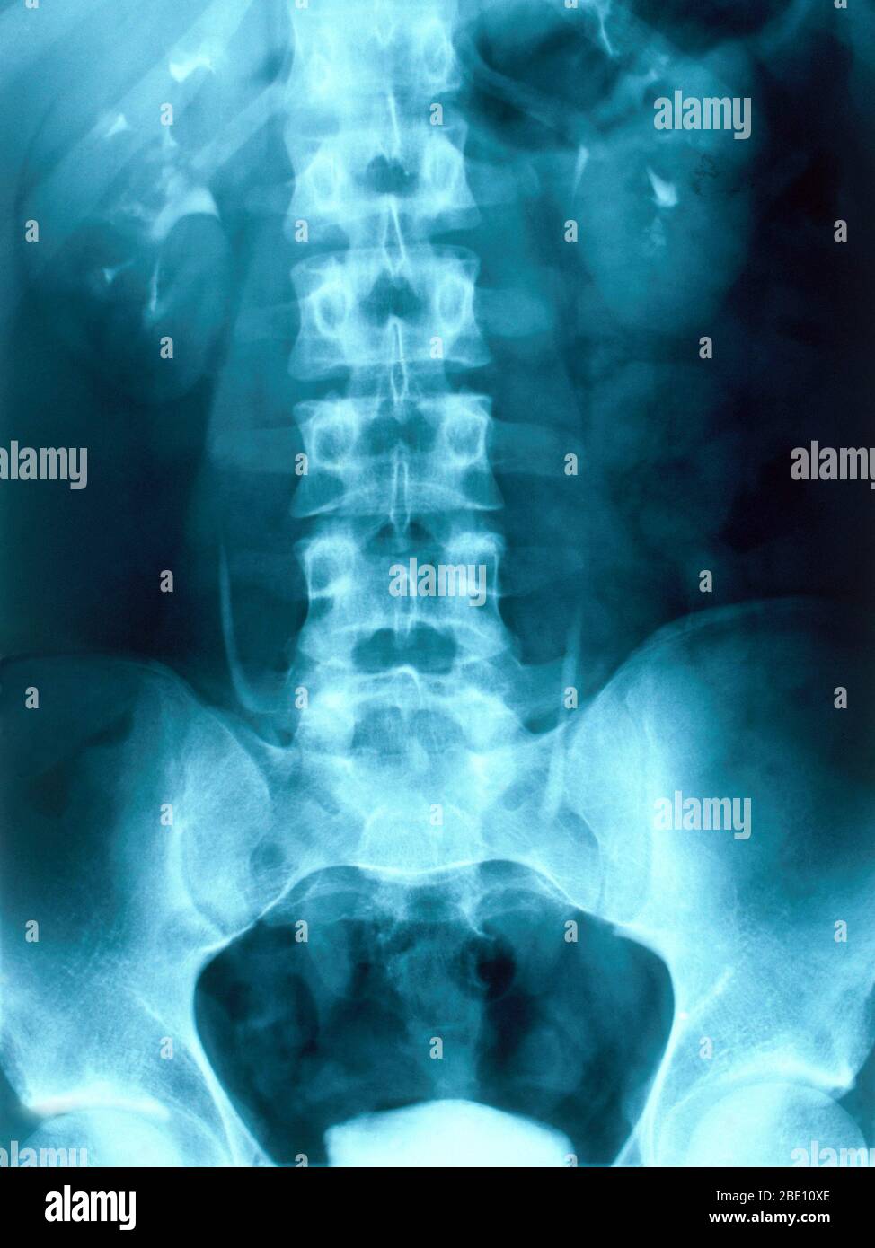 Radiografía que muestra riñones humanos normales. La función primaria del riñón es mantener el equilibrio homeostático de los fluidos corporales. Foto de stock