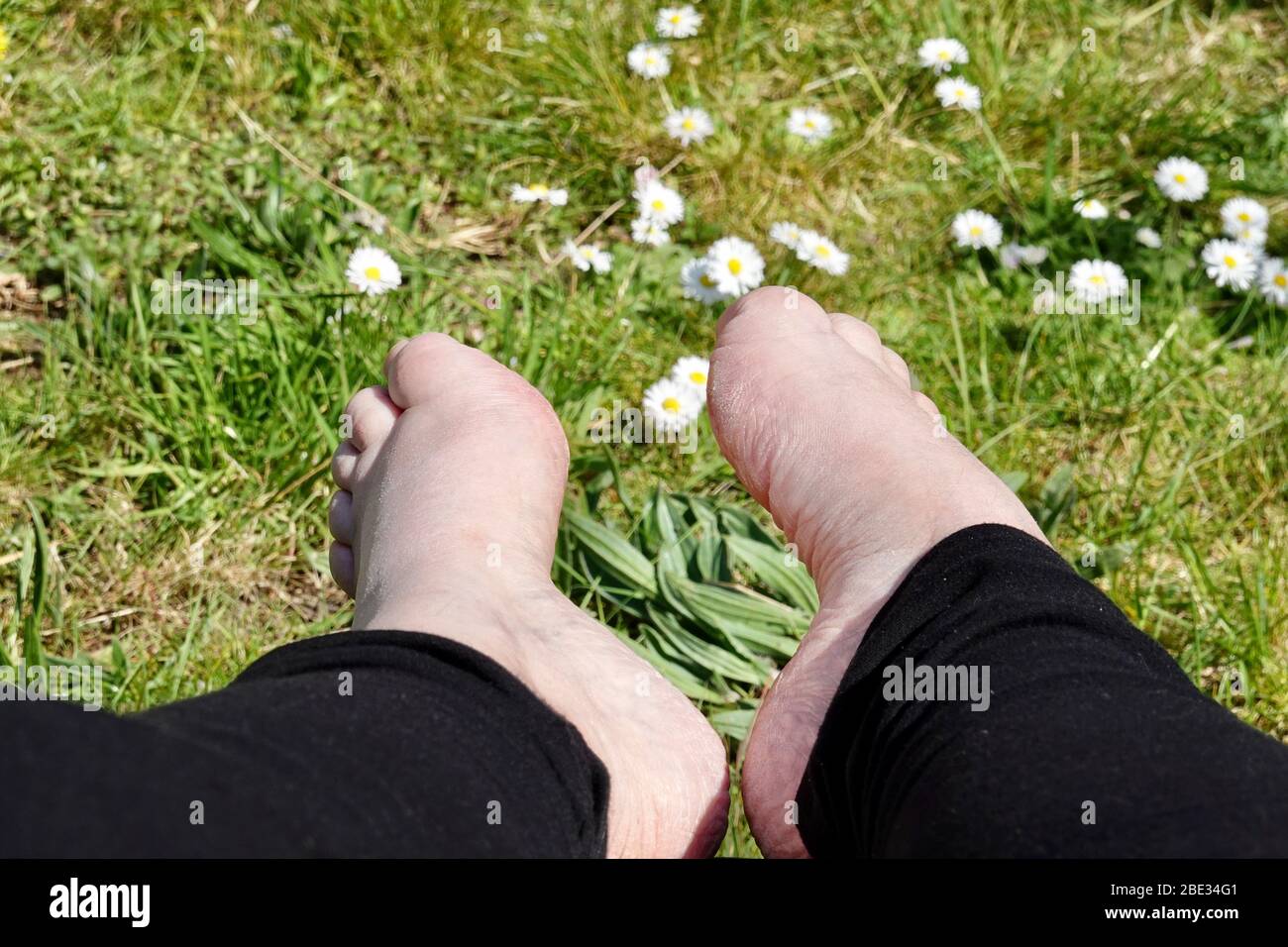 Ipswich, Reino Unido Hembra de mediana edad con deformidad del pie