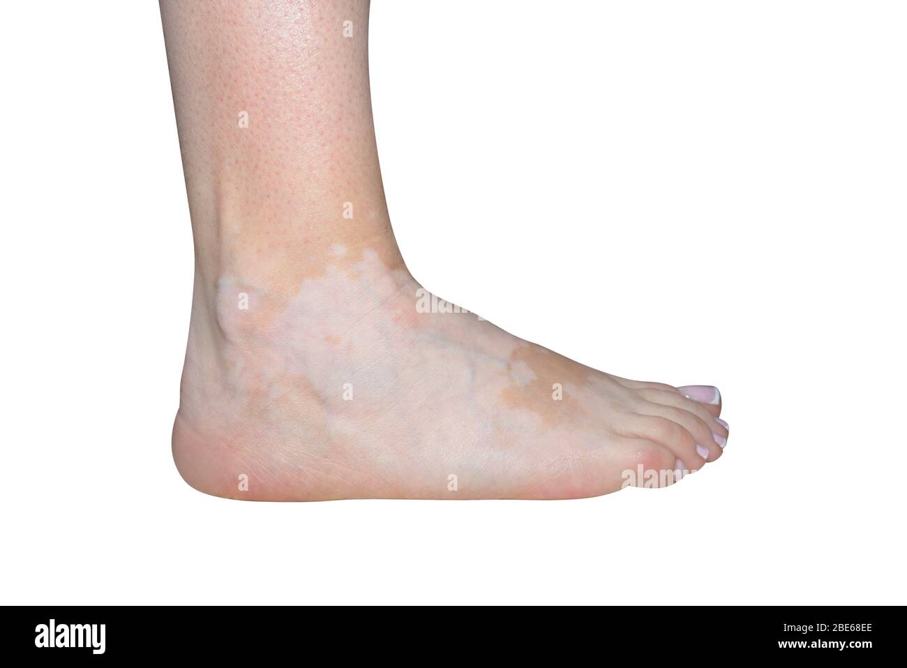 Manchas de la enfermedad del vitiligo en el pie derecho en una mujer