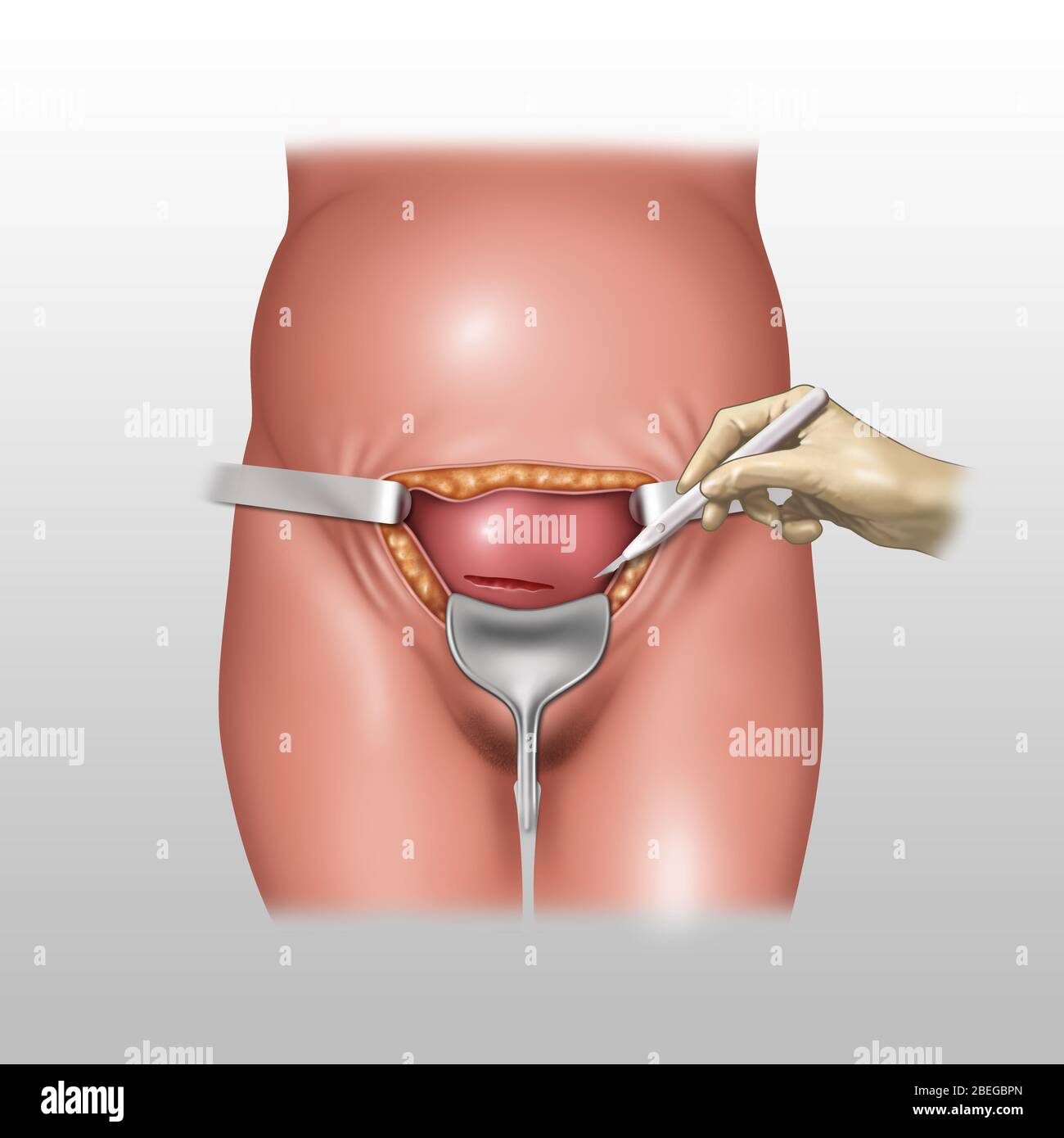 Cesarean section birth fotografías e imágenes de alta resolución