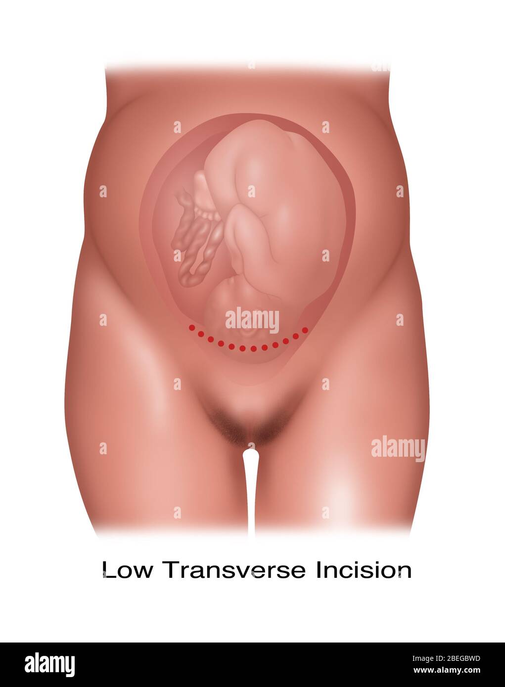 Ilustración de una incisión cesariana transversal baja utilizada para administrar un feto con posición normal. Foto de stock