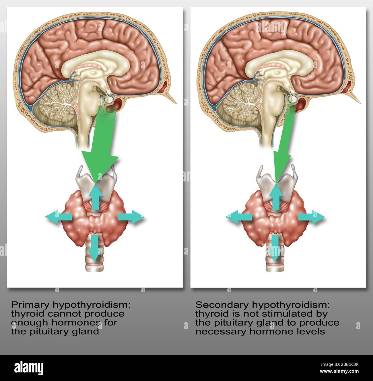 Hipotiroidismo Primario Y Secundario Ilustración Fotografía De Stock