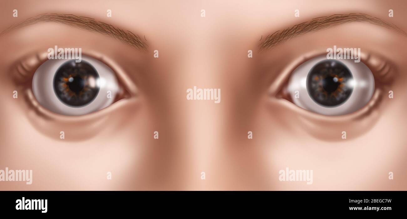 Ojos abultados, Ilustración Foto de stock