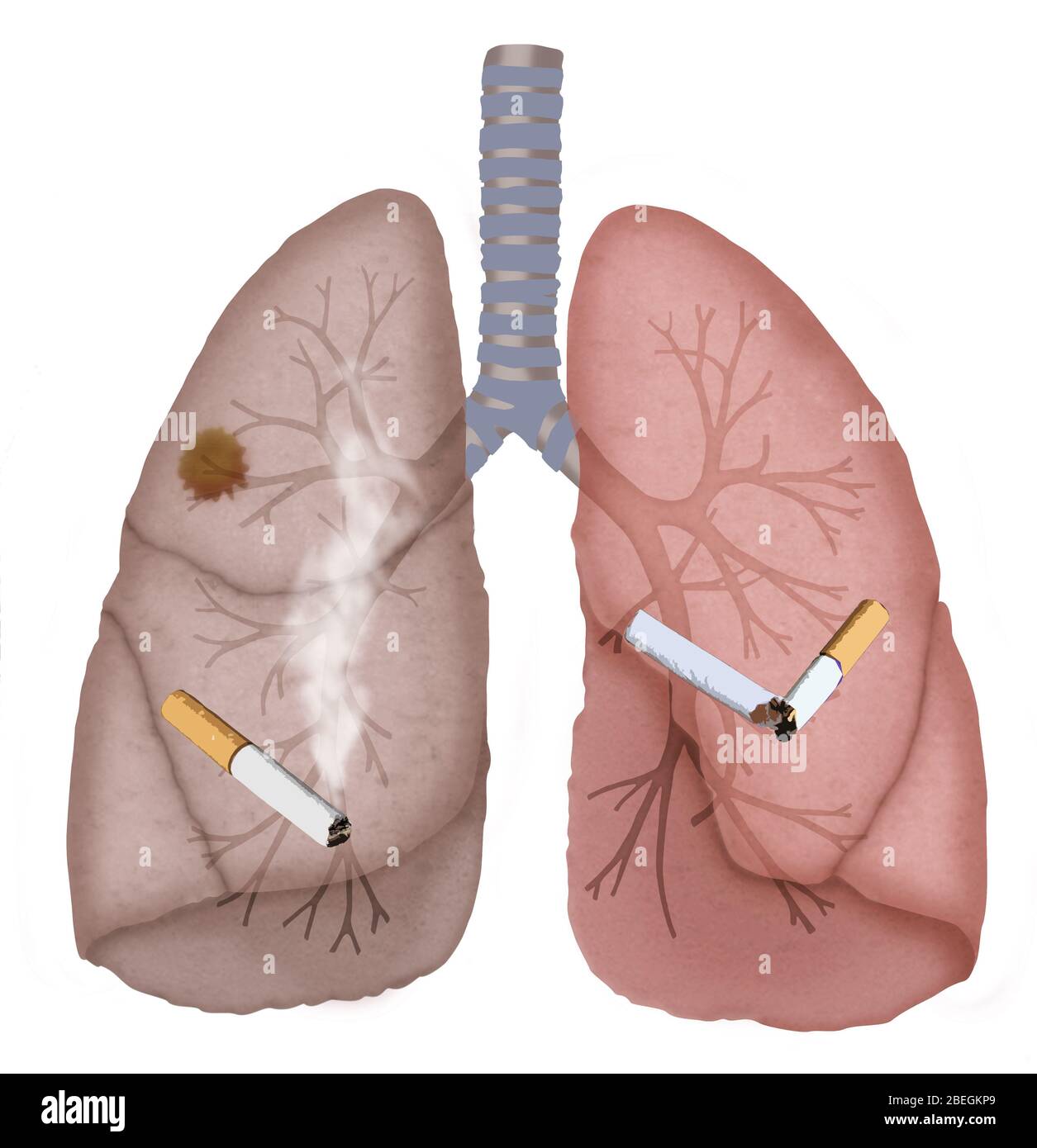 Pulmones fumadores sanos fotografías e imágenes de alta resolución - Alamy