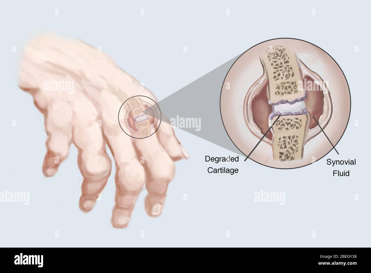 Artritis reumatoide. Foto de stock