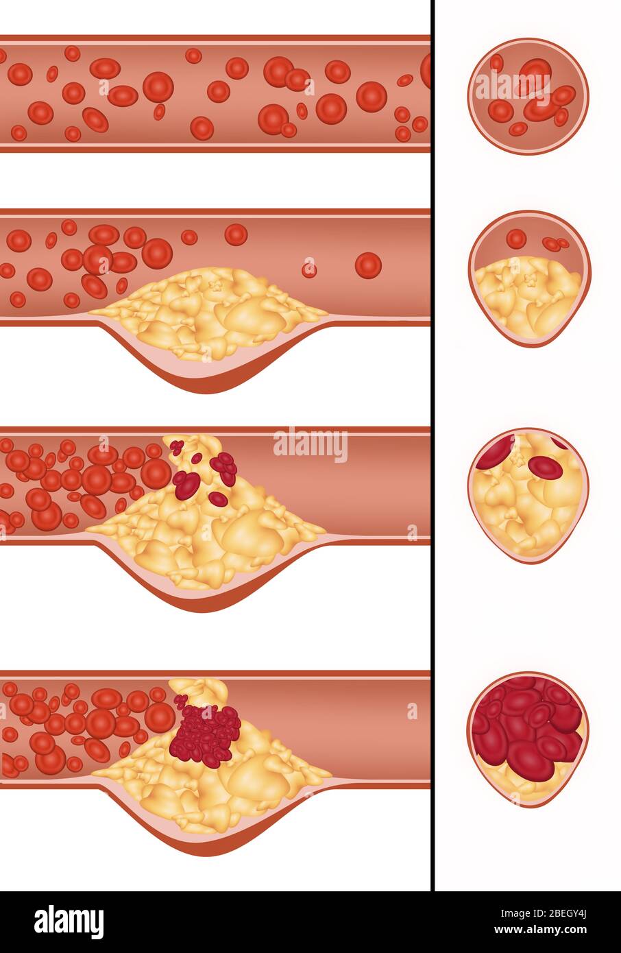Placa De Ateroma Fotos e Imágenes de stock - Alamy