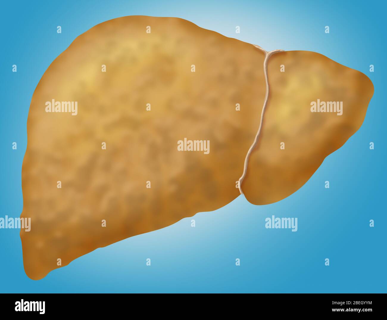 La enfermedad de hígado graso Foto de stock