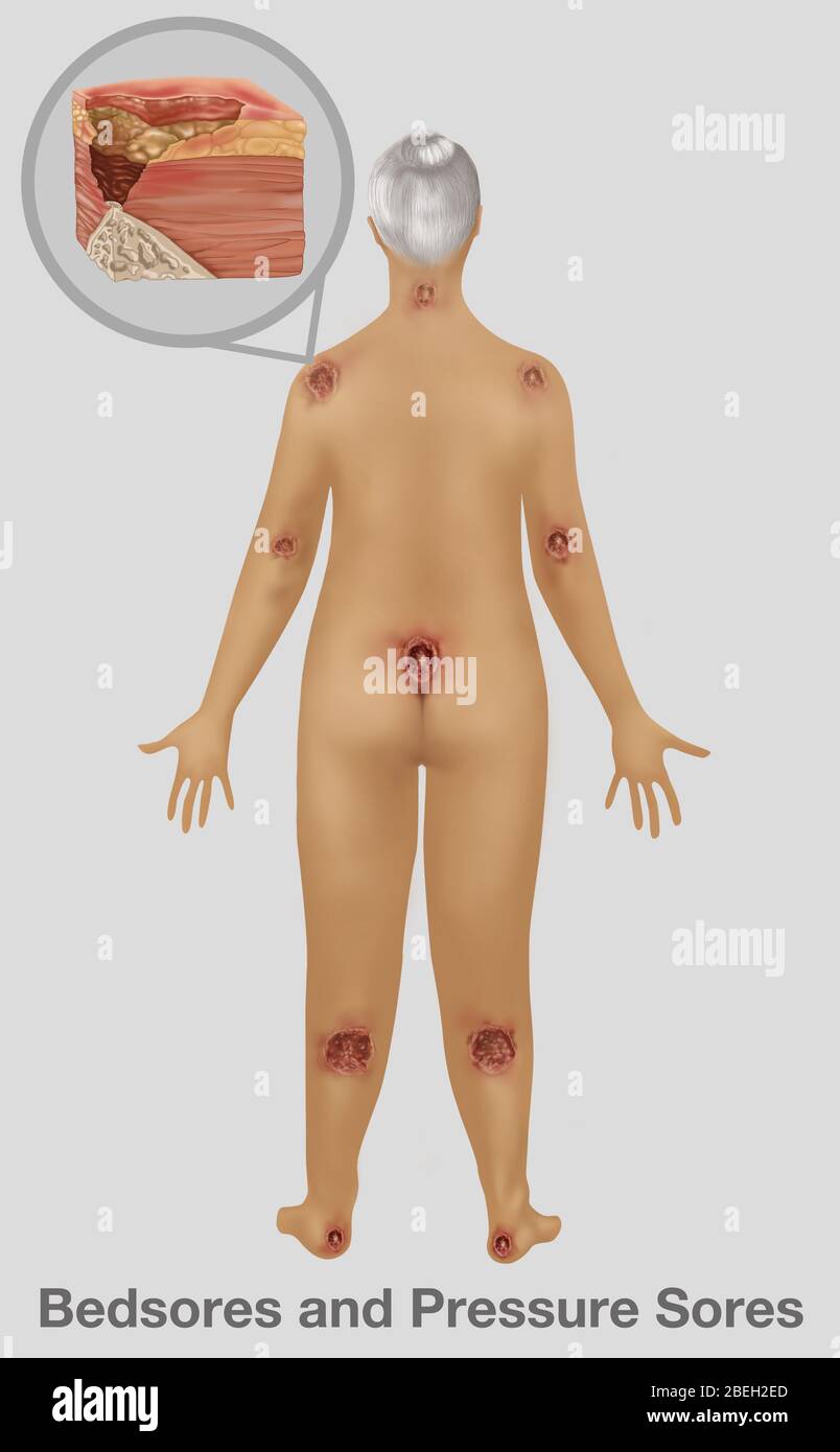 Mujer con llagas por presion fotografías e imágenes de alta resolución -  Alamy