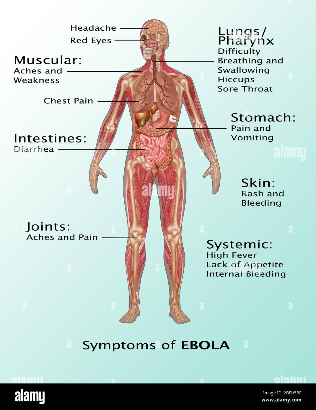Síntomas del virus del Ébola en humanos Foto de stock