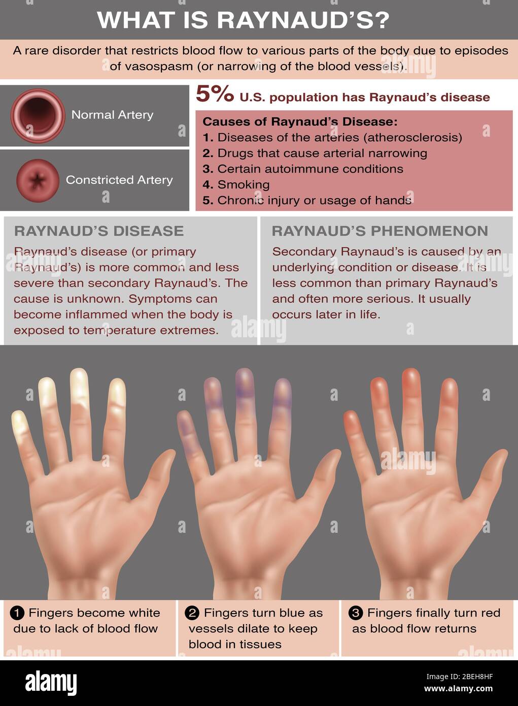 Folleto de información sobre la enfermedad de raynaud fotografías e