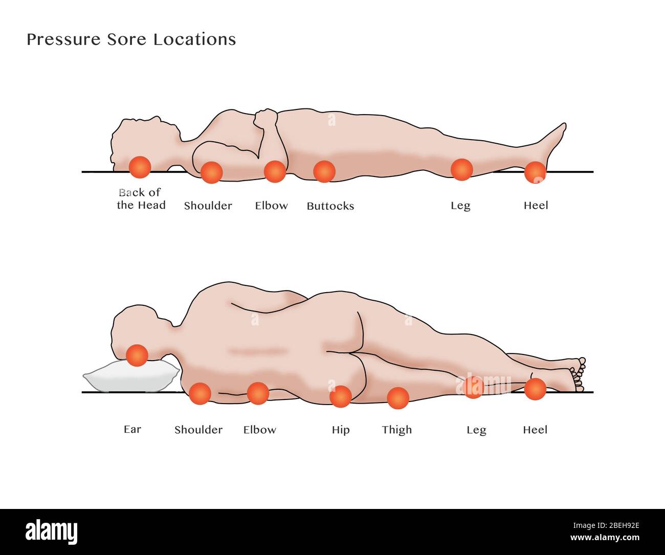 Pressure sore fotografías e imágenes de alta resolución - Alamy