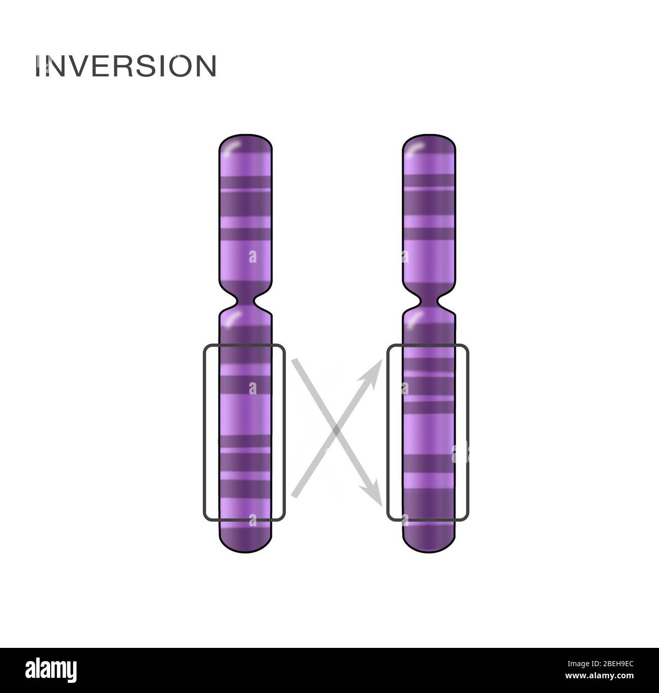 Anomalías cromosómicas únicas. Inversión cromosómica. Ilustración. Foto de stock