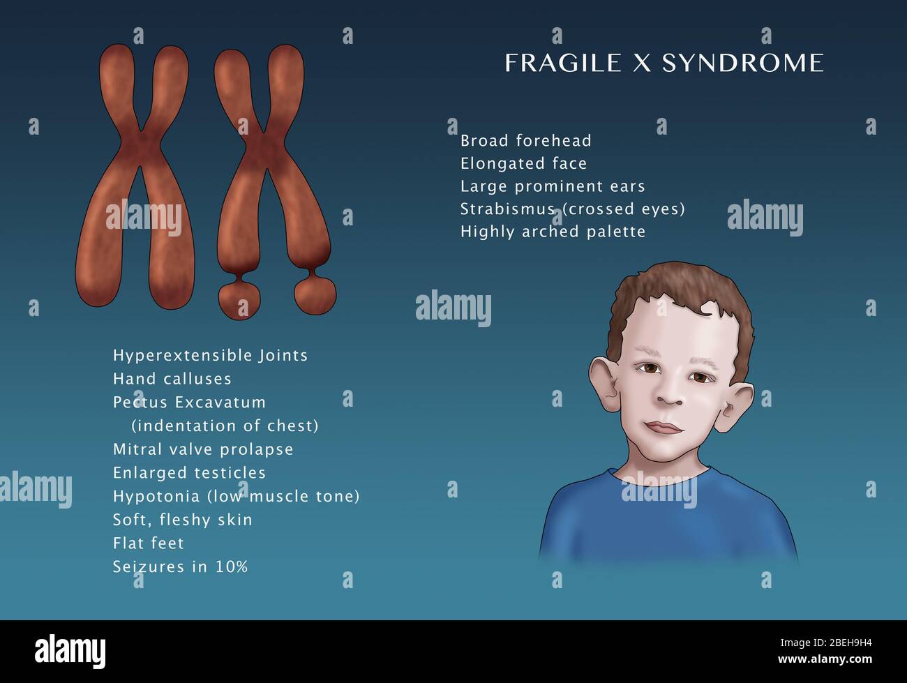 Síndrome de X frágil, Ilustración Fotografía de stock Alamy Síndrome de X frágil, Ilustración Fotografía de stock Alamy