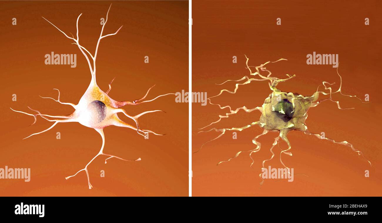 Neurona normal y moribunda, enfermedad de Alzheimer Foto de stock