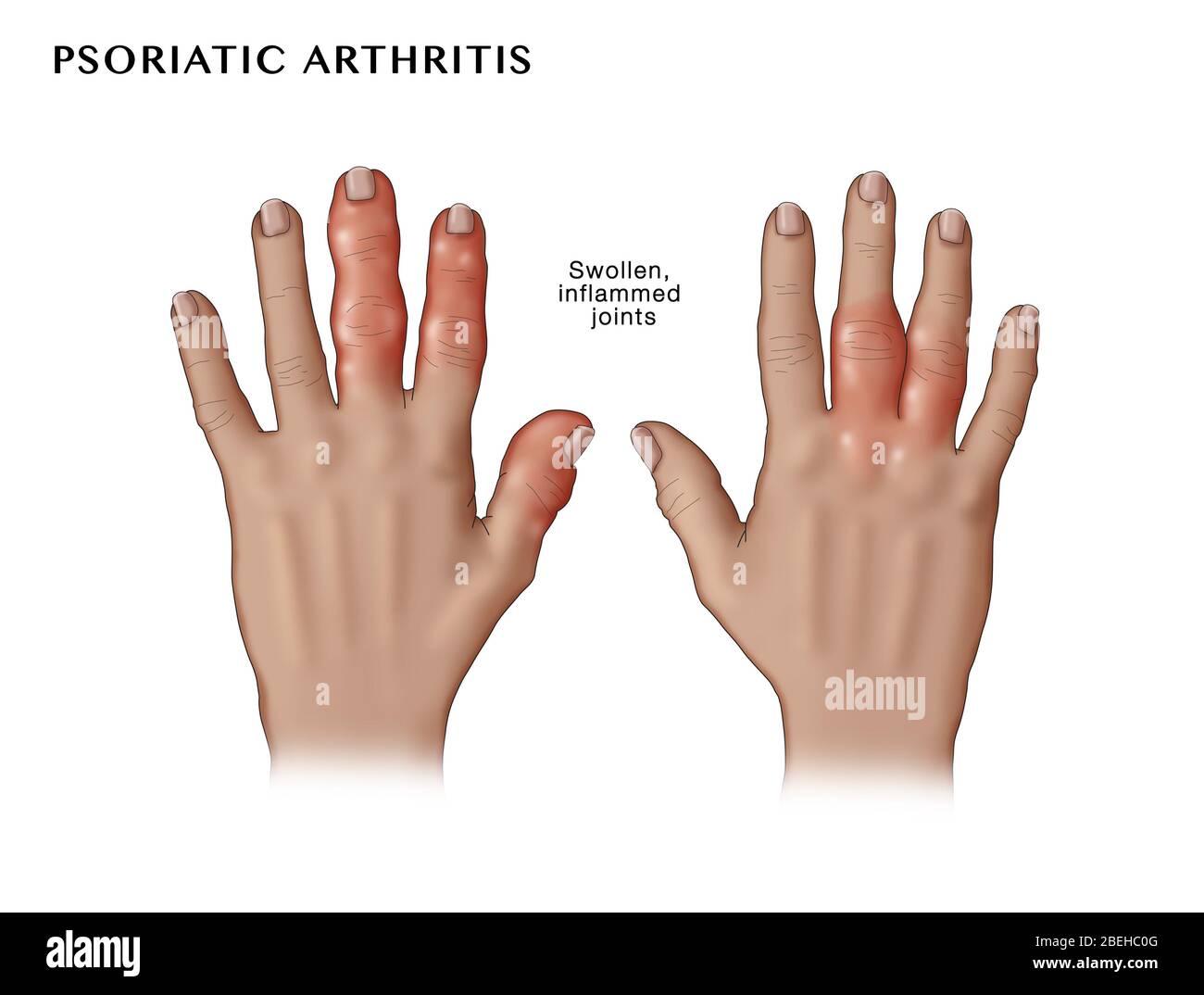 La Artritis Psoriásica Fotografía de stock Alamy
